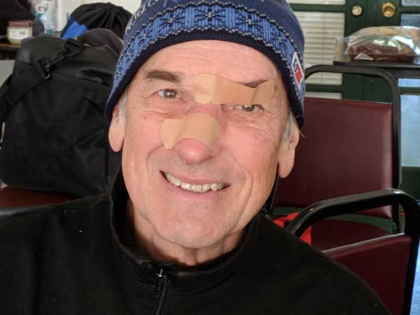 Chris Jones bandaged up from skier-into-skier crash